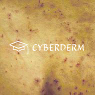 Dermatitis herpetiformis Duhring