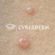 Molluscum contagiosum