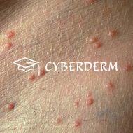 Molluscum contagiosum