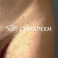 Molluscum contagiosum