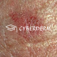 Lupus erythematodes_89