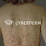Neurofibromatosis generalisata_87