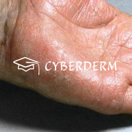 Dyshidrotisches Ekzem