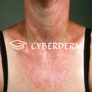 Lupus erythematodes