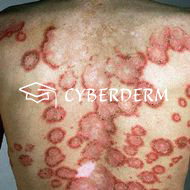 Lupus erythematodes
