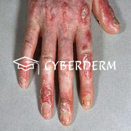 Lupus erythematodes
