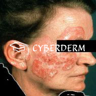 Lupus erythematodes