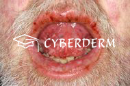 Toxische epidermale Nekrolyse