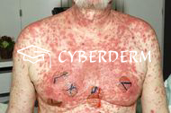 Toxische epidermale Nekrolyse
