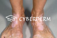 Vitiligo