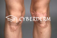 Vitiligo
