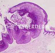 Molluscum contagiosum