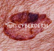 Seborrhoische Keratose