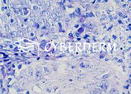 Leishmaniasis