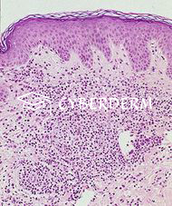 Leishmaniasis