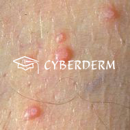 Molluscum contagiosum_Papel (Knoetchen)
