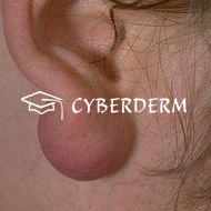 Keloid_Nodus (Knoten, auch Zyste)