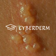 Vesicula, Bulla (Bläschen, Blase)_Vesicula (Bläschen)