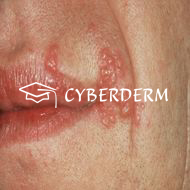 Herpes simplex_Vesicula, Bulla (Bläschen, Blase)