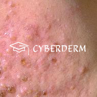 Follikulitis_Pustula (Pustel)_Pustula (Pustel)