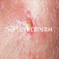 Follikulitis_Pustula (Pustel)