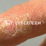 Palmoplantare Keratosen_Squama (Schuppe)