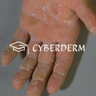 Palmoplantare Keratosen_Squama (Schuppe)