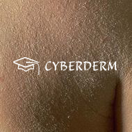 Ichthyosen_Squama (Schuppe)_Squama (Schuppe)
