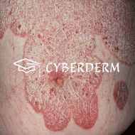Psoriasis_Squama (Schuppe)