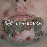 Impetigo contagiosa_Crusta (Kruste)