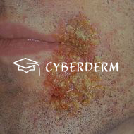 Impetigo contagiosa_Crusta (Kruste)