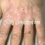 Porphyria cutanea tarda_Excoriatio (Exkoriation)_Erosio (Erosion)