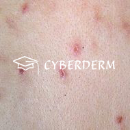 Artefaktdermatitis_Excoriatio (Exkoriation)_Erosio (Erosion)