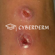 Gonorrhoe_Ulcus (Ulkus)