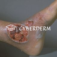 Ulcus (Ulkus)_Ulcus (Ulkus)