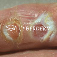 Ulcus (Ulkus)_Ulcus (Ulkus)