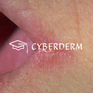 Candidiasis_Fissura/Rhagade_Fissura