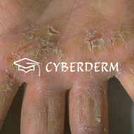 Palmoplantare Keratosen_Fissura/Rhagade_Rhagade