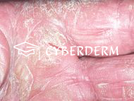 Palmoplantare Keratosen_Fissura/Rhagade