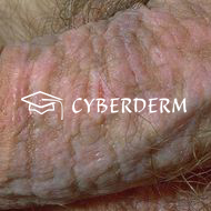 Palmoplantare Keratosen_Fissura/Rhagade_Rhagade