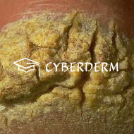 Palmoplantare Keratosen_Fissura/Rhagade