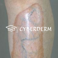 Hautveränderungen bei Diabetes mellitus_Atrophie_Atrophie