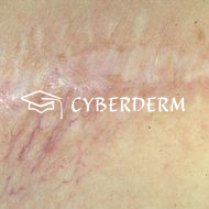 Zirkumskripte Sklerodermie_Atrophie