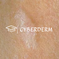 Zirkumskripte Sklerodermie_Atrophie