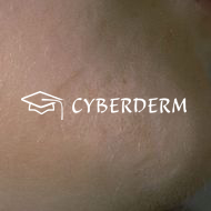 Zirkumskripte Sklerodermie_Atrophie_Atrophie