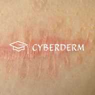 Cicatrix (Narbe)_Cicatrix (Narbe)