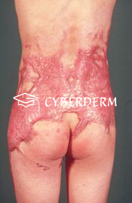 Keloid_Cicatrix (Narbe)