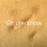 Cicatrix (Narbe)_Cicatrix (Narbe)