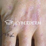 Lichen (ruber) planus_Cicatrix (Narbe)