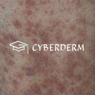 Allergische Vaskulitis